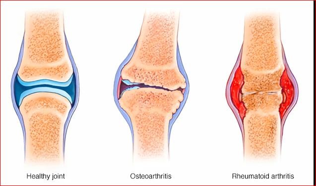 Types of arthritis osteoarthritis and Rheumatoid arthritis   