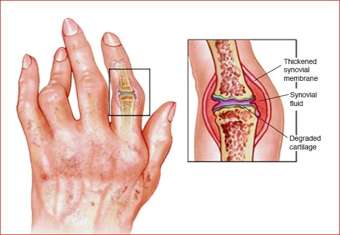 Arthritis symptoms causes and precaution with home remedies